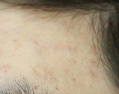 헤어라인 편평사마귀 치료 후