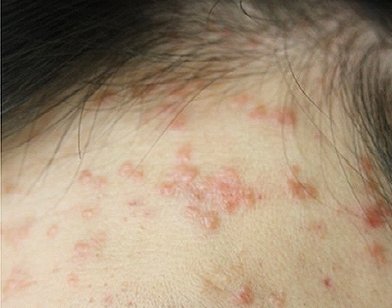 헤어라인 편평사마귀 치료 전